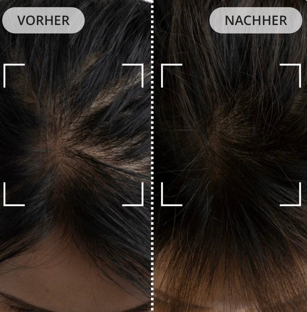 Dermaled® Pro gegen Haarausfall