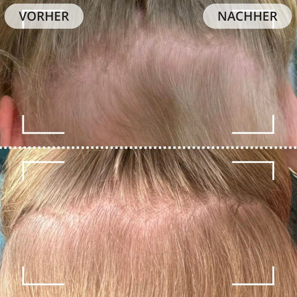 Dermaled® Pro gegen Haarausfall