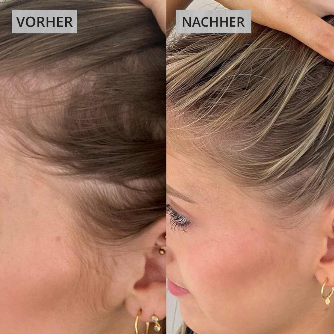 Dermaled® Pro gegen Haarausfall